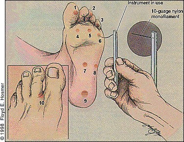 Monofilament testing in diabetic foot – GPnotebook