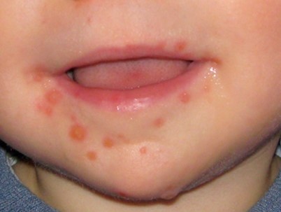 Primary Herpes Simplex Infection In A Baby