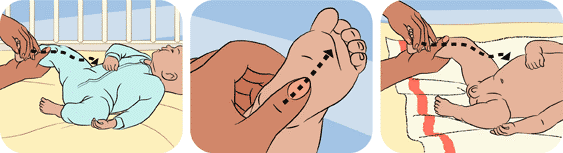 Stretching Exercises For Child's Clubbed Foot