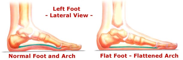 Flat feet in children - HSE.ie