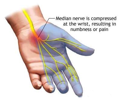 Physiotherapy Management of Carpal Tunnel Syndrome (CTS) - PORTAL