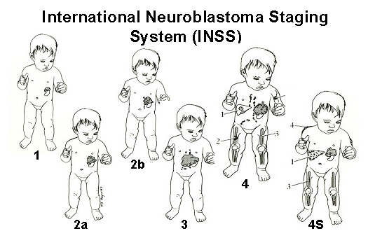 neuroblastoma5