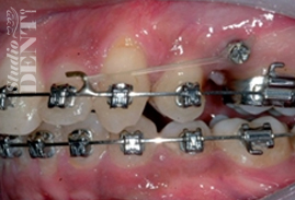 Do you know that minivis can help shorten the period of treatment in  orthodontics? 