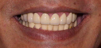 Orthodontics Treatment to realign the teeth with orthodontic braces