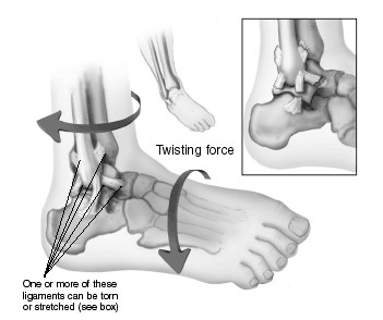 Ankle Sprain Rehabilitation - PHYSIOTHERAPY PERSPECTIVE